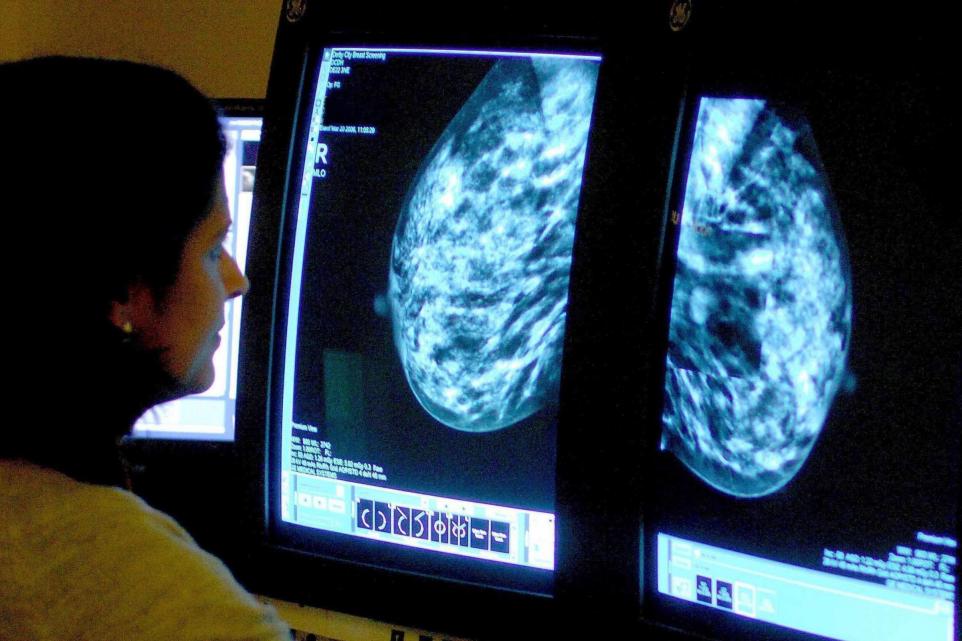 AI Tool Predicts Breast Cancer Treatment Side Effects
