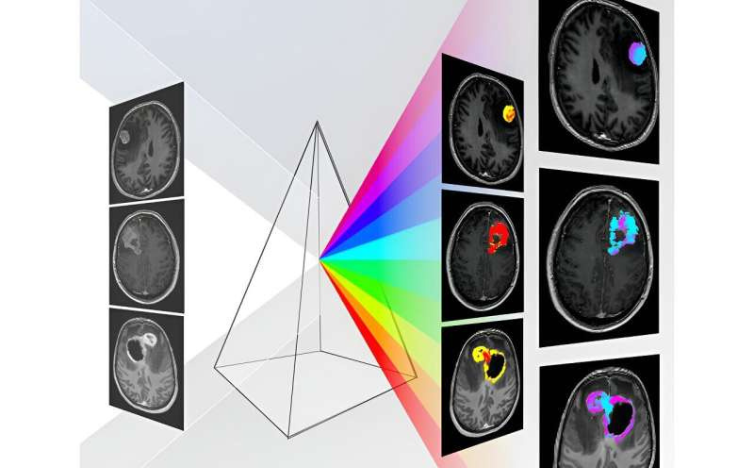 AI Tool Enables Precise Brain Tumor Diagnosis Sans Surgery