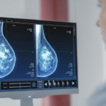 AI Tool Finds 30% More Breast Cancers Missed by MRI Scans