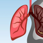 AI Tool to Detect Lung Cancer Launches at Tameside Hospital