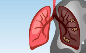 Read more about the article AI Tool to Detect Lung Cancer Launches at Tameside Hospital