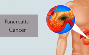 Read more about the article AI Tool Revolutionizes Pancreatic Cancer Diagnosis