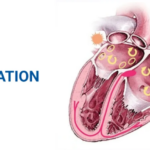 AI Tool Helps Detect Atrial Fibrillation Risk in Leeds Trial