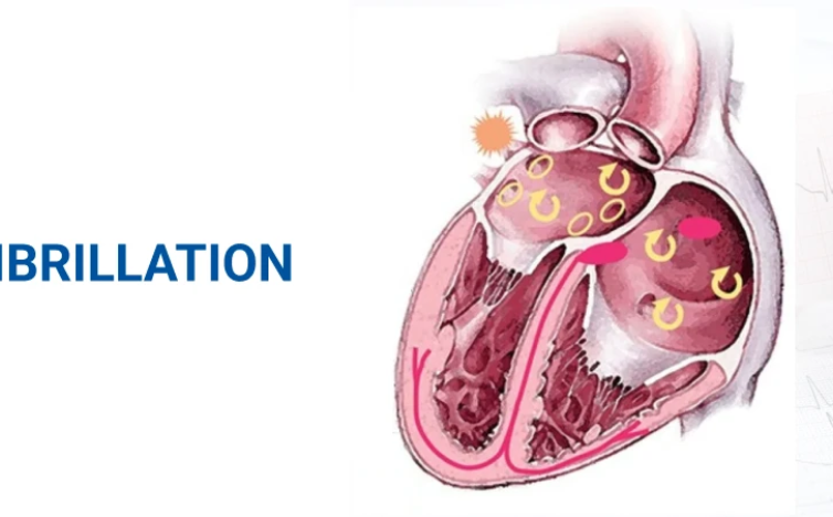 Read more about the article AI Tool Helps Detect Atrial Fibrillation Risk in Leeds Trial