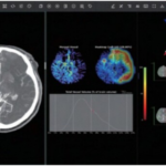 Japan Approves JLK’s AI Tool for Faster Stroke Diagnosis