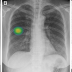 AI System Helps Detect Airway Nodules on Chest CT Scans