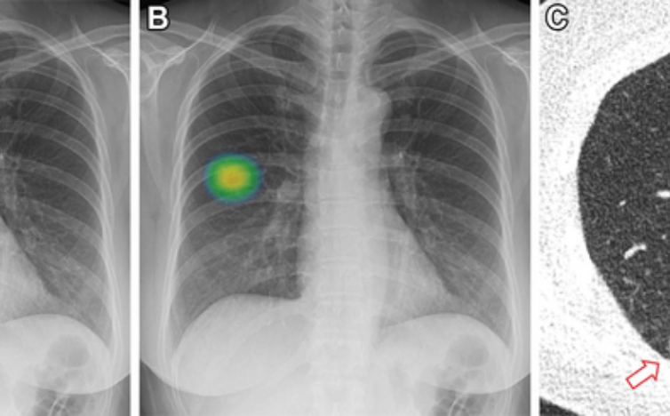 You are currently viewing AI System Helps Detect Airway Nodules on Chest CT Scans