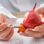 AI Helps Decide Hormone Therapy Length in Prostate Cancer